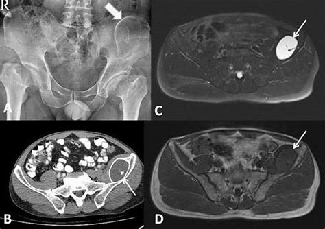 A Antero Posterior Pelvis Radiograph Showing Large Ovoid Shaped Download Scientific Diagram