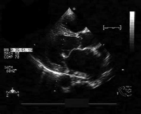 Mitral Valve Stenosis Ultrasound