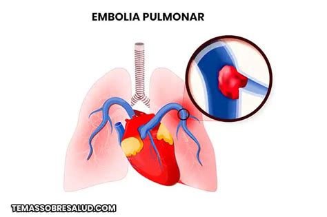 Embolia Pulmonar Síntomas diagnostico y tratamiento