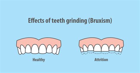 Teeth Grinding And Its Consequences