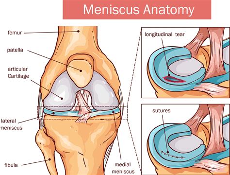 Meniscus vs. Cartilage Tear of the Knee