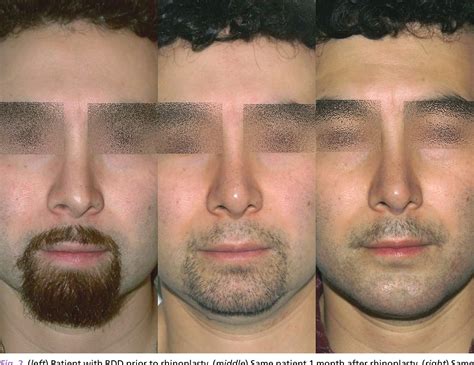 Figure 2 From Body Dysmorphic Disorder Semantic Scholar