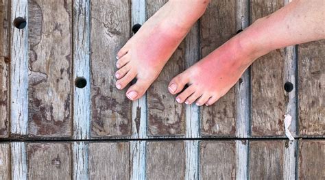 What Is Sun Poisoning Causes Symptoms And Treatment