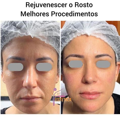 Rejuvenescer O Rosto Melhores Procedimentos Cl Nica Fit Body Est Tica