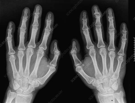 Osteoarthritis in the hands, X-ray - Stock Image C016/8214 - Science ...