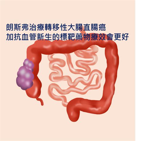 朗斯弗治療轉移性大腸直腸癌 加上抗血管新生的標靶藥物療效會更好 陳駿逸醫師 與你癌歸於好