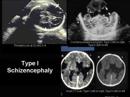 Septo Optic Dysplasia Ultrasound