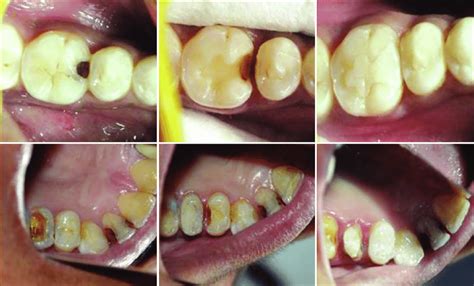 Class II Inlays In Rt Mandibular 1st Molar Zirconia Rt Maxillary