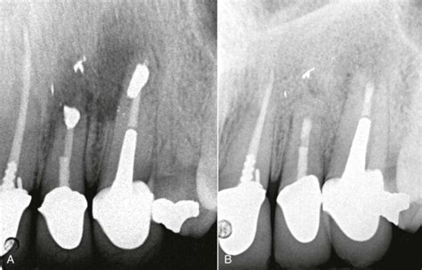 Endodontic Surgery Pocket Dentistry