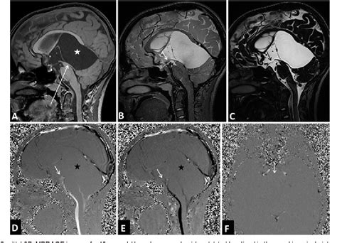 Figure 1 From Assessment Of Third Ventriculostomy Patency With The 3d Space Technique A