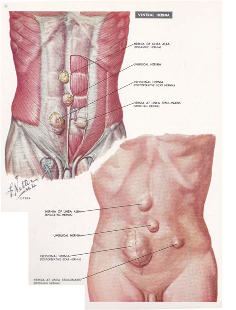 Ernie Della Parete Addominale Top Doctors