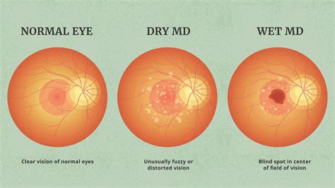 Pegcetacoplan Syfovre For Macular Degeneration An Update Science