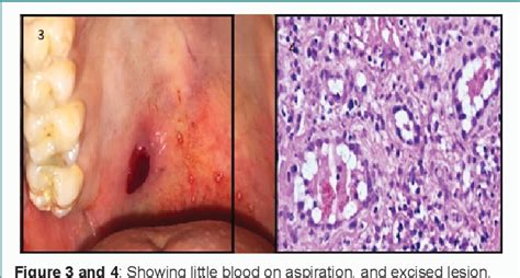 Figure 3 From Pyogenic Granuloma PG Common Lesion At Uncommon Site