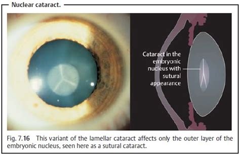 Congenital Cataract