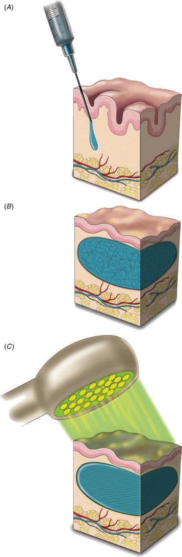 Injection Of Photoactivated Peg Ha Hydrogel Hillel Et Al Were Able To