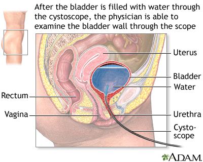 Cystoscopy - UF Health