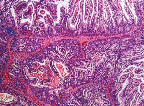 Hamartoma, a typical PJS polyp demonstrating the arborizing pattern of... | Download Scientific ...