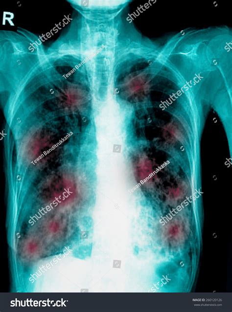 Film Chest Xray Show Cavity Right Stock Photo Shutterstock