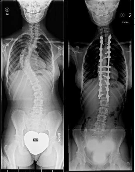 Patient Story Chiari Malformation And Scoliosis Orthoinfo Aaos