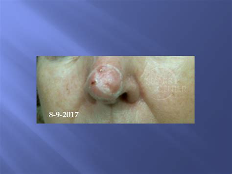 EXTENSIVE NASAL TIP BASAL CELL CARCINOMA - Skin Cancer and Reconstructive Surgery Center