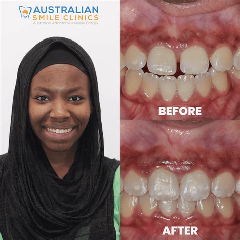 Affordable Clear Aligners Australian Smile Clinics