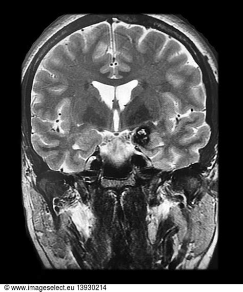 Cavernous Malformation Frontal Lobe Mri Cavernous Malformation Frontal