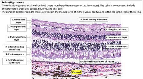 Eye Retina Choroid And Sclera Nus Pathweb Nus Pathweb