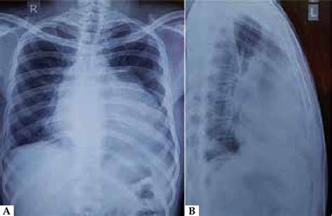 A Chest Radiograph Postero Anterior View Suggestive Of Cardiomegaly