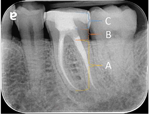 A Gutta Percha B Glass Ionomer Cement Orifice Barrier C Resin