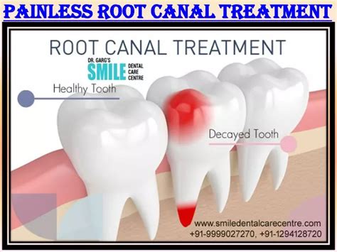 Ppt Painless Root Canal Treatment In Faridabad Visit To Get