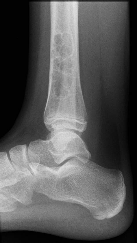 Non Ossifying Fibroma Fibroxanthoma Radrounds Radiology Network