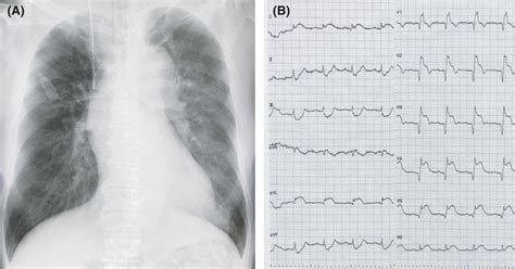 A Preoperative Chest X‐ray Showing A Widened Superior Mediastinum And Download Scientific