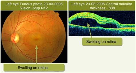 Drushti|Eye and Retina Center:-Central Serous Retinopathy