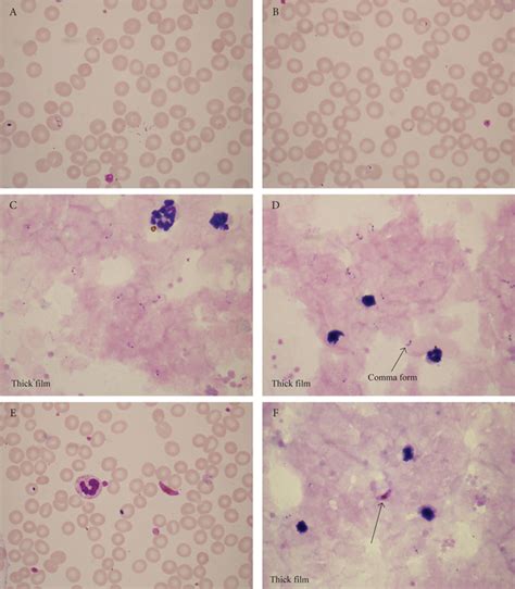 Microscopical Diagnosis Of Blood Parasites Haema