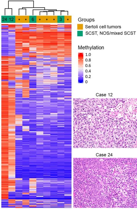 Clinicopathologic And Molecular Spectrum Of Testicular Sex Cord Stromal