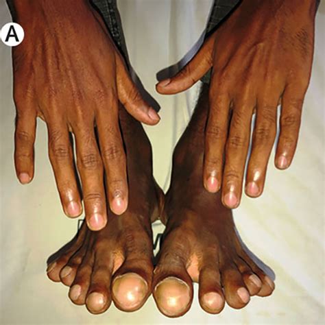 Differential Clubbing And Cyanosis NEJM, 46% OFF