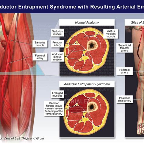 Left Adductor Entrapment Syndrome With Resulting Arterial Embolism Trialexhibits Inc