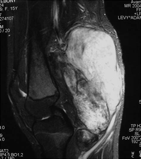 Mesenchymal Chondrosarcoma Tumors Of The Bone