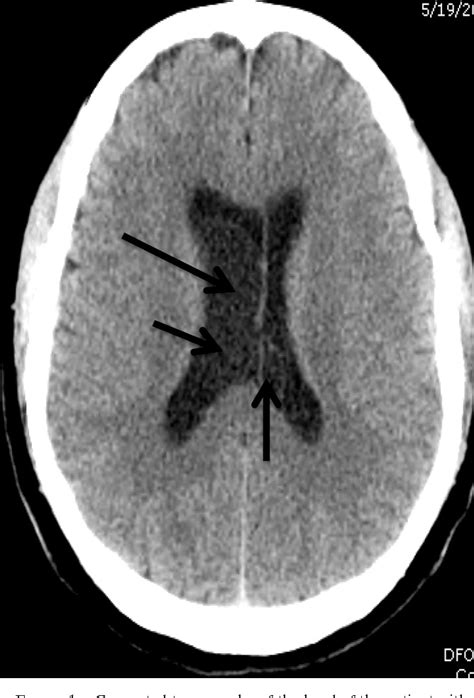 Figure 1 From Multiple Intraventricular Neurocysticercal Cysts Treated With Endoscopy Without