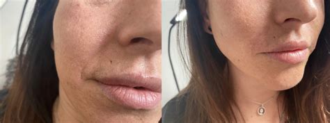 Aesthetics Fillers And Anti Wrinkle Treatments Perfect Aesthetics