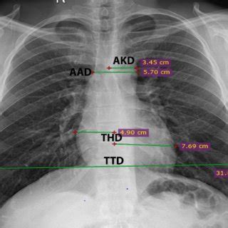 The Mean Aortic Knob Diameter of 294 Participants | Download Scientific ...