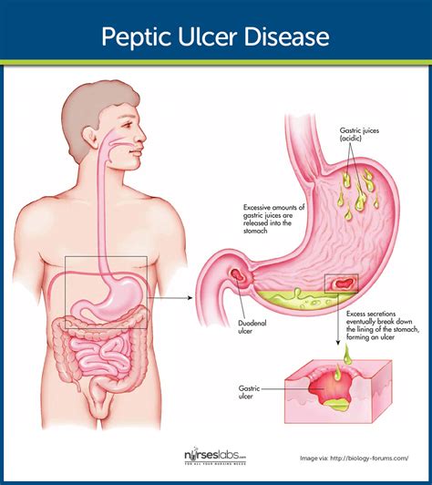 Peptic Ulcer Disease Nursing Care And Management Study Guide Peptic