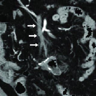 Contrast-enhanced computed tomography reveals thrombosis in the SMV ...