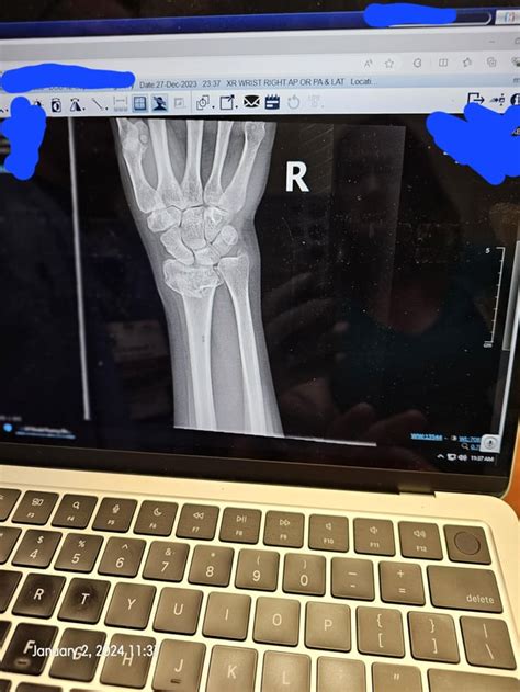 Broken wrist surgery/ follow-up : r/MedicalGore