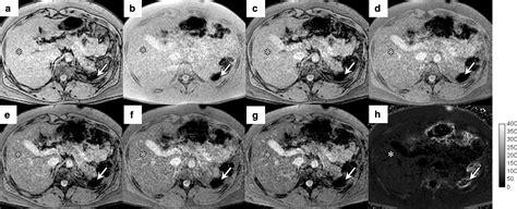 Liver Iron Quantification With Mr Imaging A Primer For Radiologists Radiographics