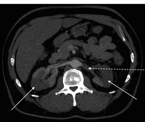 Computed Tomography Showing Bilateral Renal Infarcts Arrows And Left Download Scientific