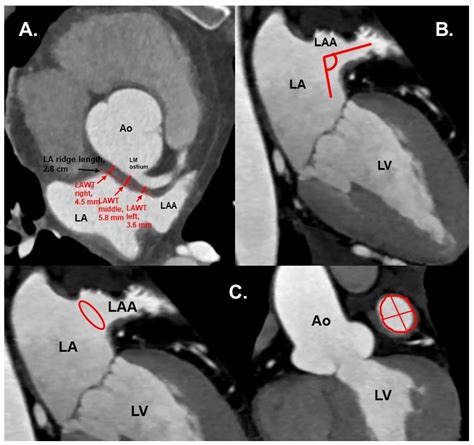 Jcm Free Full Text Left Atrial Appendage Morphology And Left Atrial Wall Thickness Are