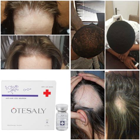 50ml Otesaly Price Hair Restoration Anti Hair Loss Mesotherapy Solution