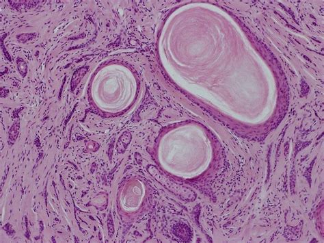 Desmoplastic trichoepithelioma - Alchetron, the free social encyclopedia