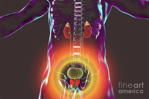 Benign Prostatic Hyperplasia Photograph By Kateryna Kon Science Photo